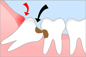    - dental diamond